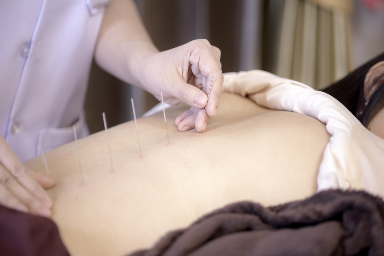 The physiotherapist is doing acupuncture on the back of a female patient. Patient is lying down on a bed.